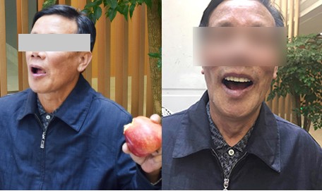 北京中诺口腔医院杨勇全口牙种植案例对比效果