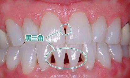 牙齿矫正产生的“黑三角”不可逆的吗？跟医生技术有关吗