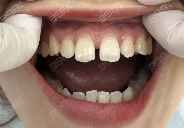 美白牙齿做牙贴面可以维持多久有后遗症吗费用一般多少钱
