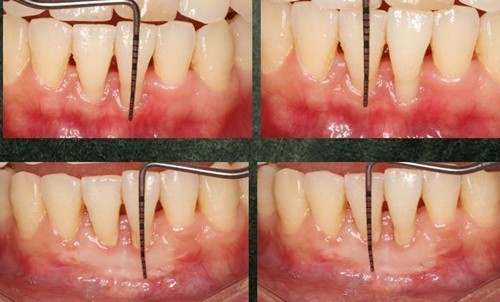 牙周袋深度三级分类:自行治疗不可取,具体治疗方案看这里!