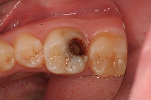 牙齿烂洞长期不补会怎样？