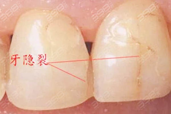 分享一波牙隐裂清晰图片如果牙上有裂纹还能长好吗