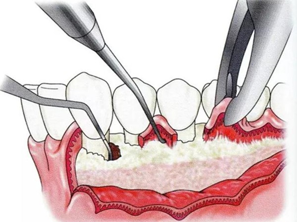 全口牙周刮治多少钱一次?想知道做完龈下刮治能治好牙周炎吗?