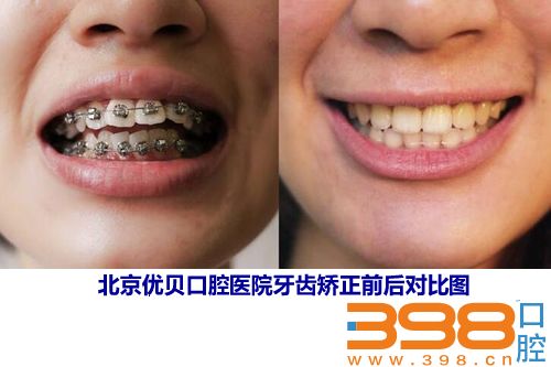 北京优贝口腔医院牙齿矫正前后对比图