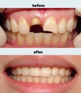 牙齿修复前后对比照片图片