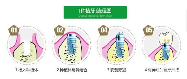 老人牙齿缺失真的没必要再种植吗?建议替爸妈收藏