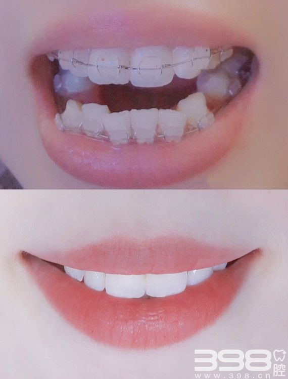 小仙女牙套龅牙牙齿不齐 分享两年陶瓷牙套矫正
