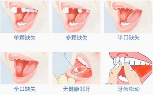 种植牙收费价格表又更新啦！看西安哪家牙科便宜又好？