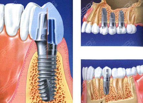 北京哪个医院种植牙比较好？即刻种植牙贵吗？多少钱一颗？