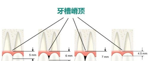 牙槽骨比例示意图