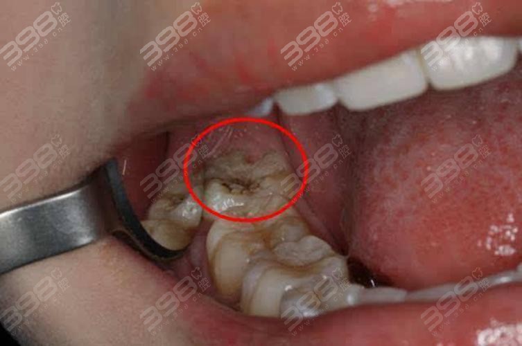 2,智齿牙龈红肿由于炎症的影响导致牙龈组织受到损伤,牙龈部位红肿
