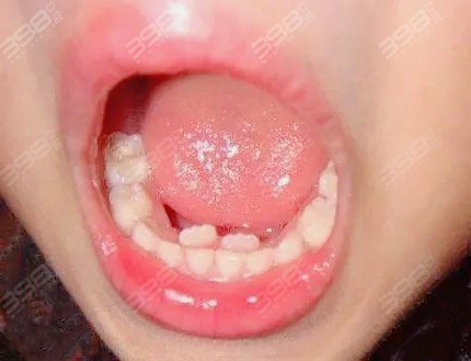 如果恒牙向外唇侧生长的力度不足,就会导致乳牙不能松动