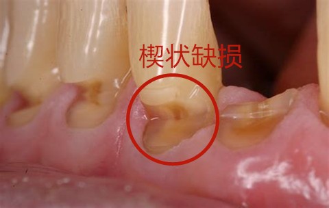 横向刷牙刷出楔状缺损怎么办?如何避免楔状缺损产生?