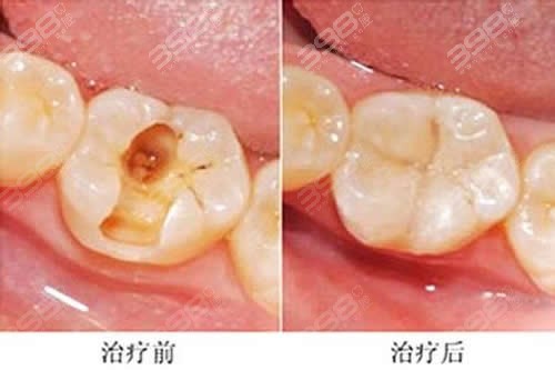 出现蛀牙了怎么办？这样做可以防止蛀牙腐蚀