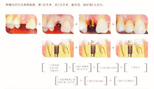 种牙两千多靠谱吗