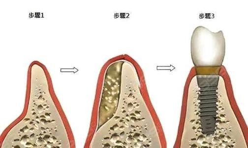 种植牙植入骨粉痛苦？手术是不是很复杂？多长时间能好？