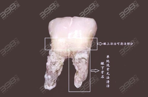 龈下刮治疼得死去活来，为什么要分4次做？