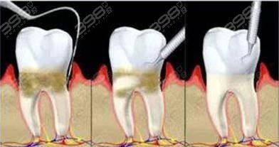龈下刮治步骤