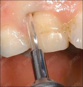 刮治的次数也会比较多,通常会分开两到三次进行治疗,治疗完后的牙周