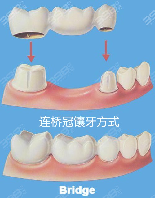 镶牙过程图解镶牙有几种方式哪个好目前镶牙价格表有吗