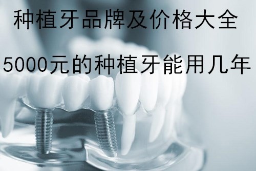 公布最新种植牙品牌及价格，5000元的种植牙能用几年？