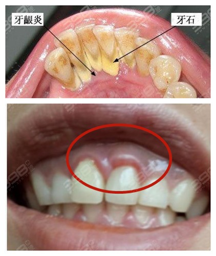看牙龈炎图片及治疗方法了解它