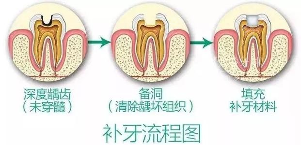 补牙过程