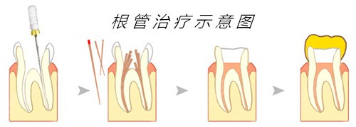 根管治疗过程