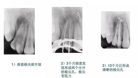 儿童根尖诱导术