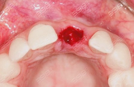 干槽症的牙洞是啥样?