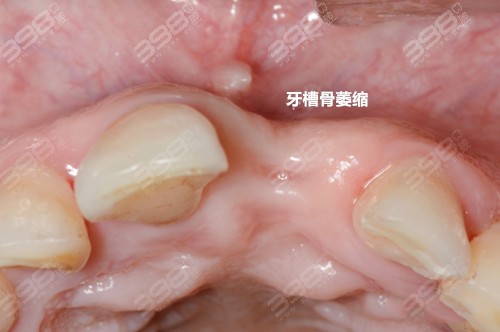 牙槽骨萎缩做gbr骨增量手术费用怎么算骨粉骨膜都要填吗