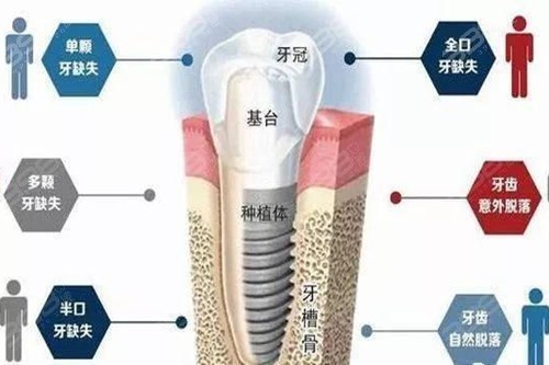 广州哪个医院种植牙便宜又好