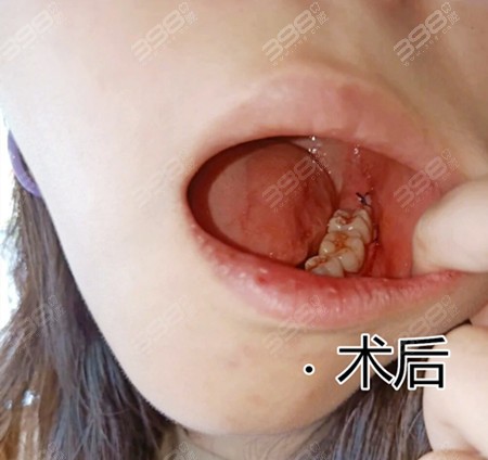 拔牙30天后牙窝状态图图片