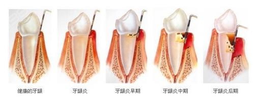 牙周炎症状有哪些