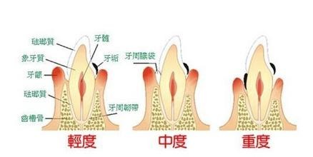 牙周炎示意图