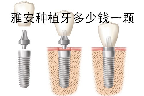 四川雅安种植牙多少钱一颗