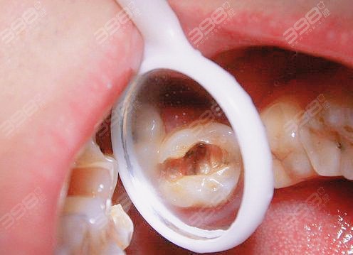 乳牙开髓孔图片
