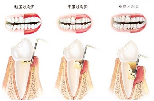 牙周炎如何引发牙龈萎缩？