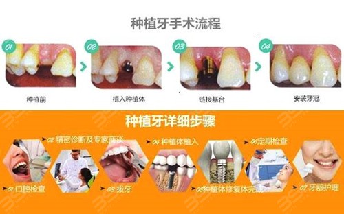 种植牙流程