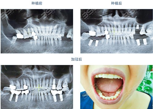 贵港种植牙多少钱一颗-百康特种植牙