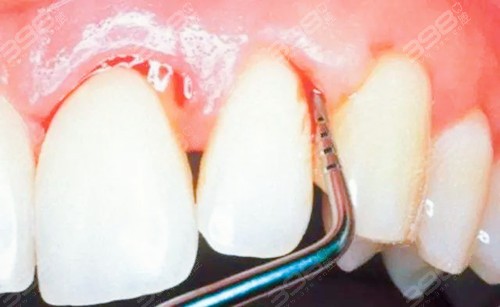 牙周袋深度三级分类自行治疗不可取具体治疗方案看这里