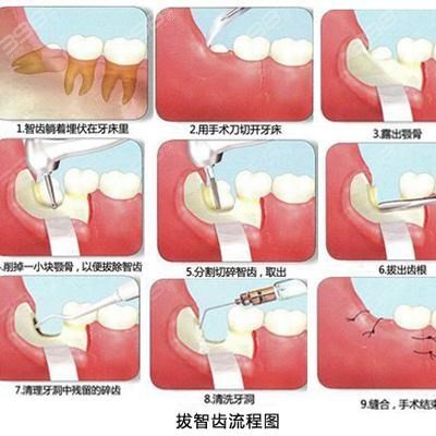 丽水拔智齿多少钱一颗