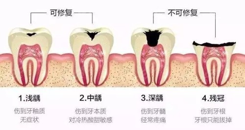 龋齿