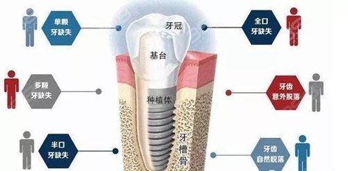 正规医院种植牙收费标准