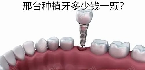 邢台种植牙多少钱一颗