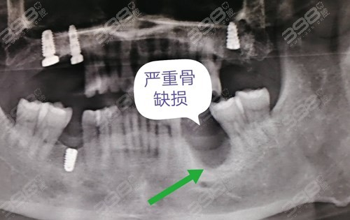 种植牙为什么要用骨粉