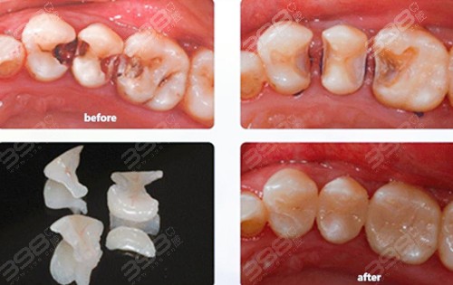 嵌体的密合度与使用寿命要远远超出树脂补牙的效果