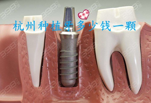 杭州种植牙多少钱一颗
