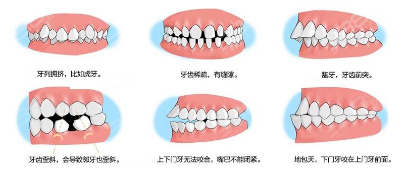 矫正的类型