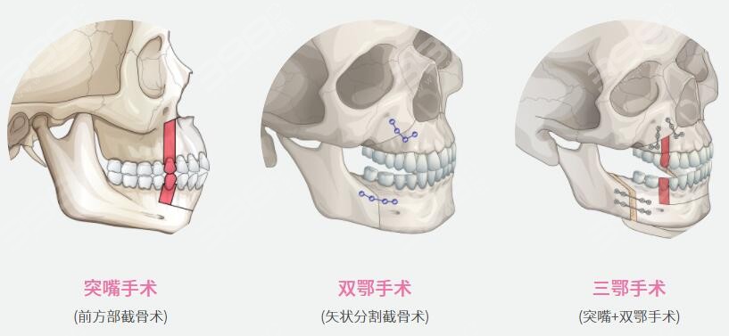 手术原理